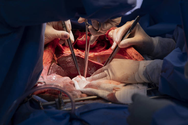 Imagem mostra momento em que fígado começa a ser retirado