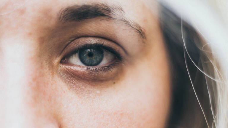 Saiba quais são os tipos de olheiras e como combatê-las