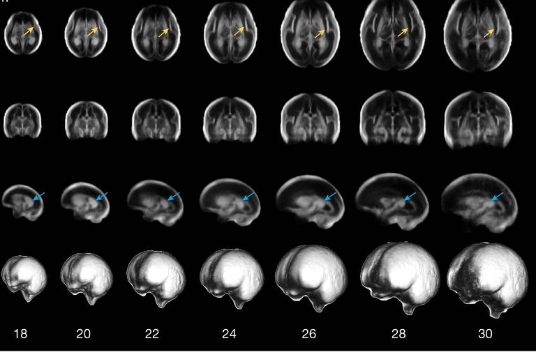 Atlas digital registra a evolução ideal do cérebro na gestação