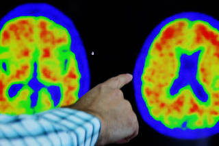 Evidence of Alzheimer?s disease on PET scans at the Center for Alzheimer Research and Treatment in Boston