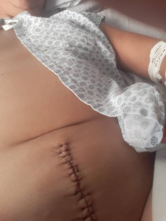 A dona de casa Andréia Rodrigues do Nascimento, 42, mostra a barriga após a cirurgia para retirada do DIU