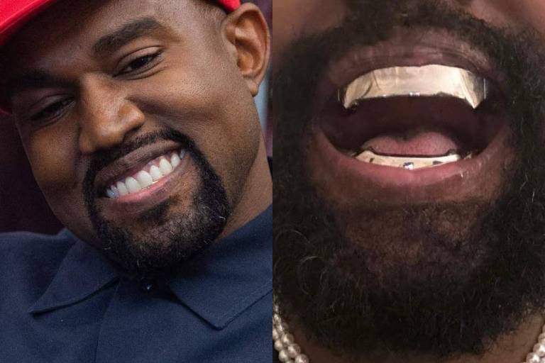 Kanye West troca os dentes por prótese que custa R$ 4 milhões
