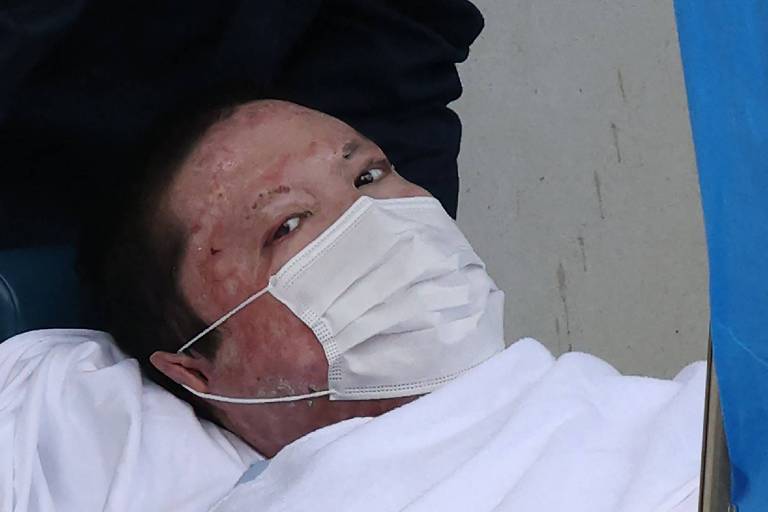 Foto mostra homem japonês deitado em uma maca; ele usa uma máscara facial que cobre seu nariz e sua boca, e tem o rosto marcado por cicatrizes de queimaduras