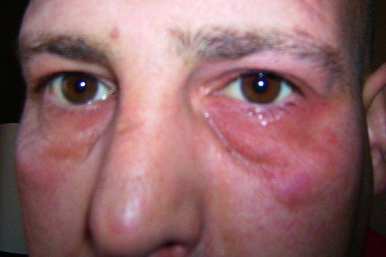 Foto aproximada do rosto de Daren Frankish, que aparece com região dos olhos inchada e avermelhada