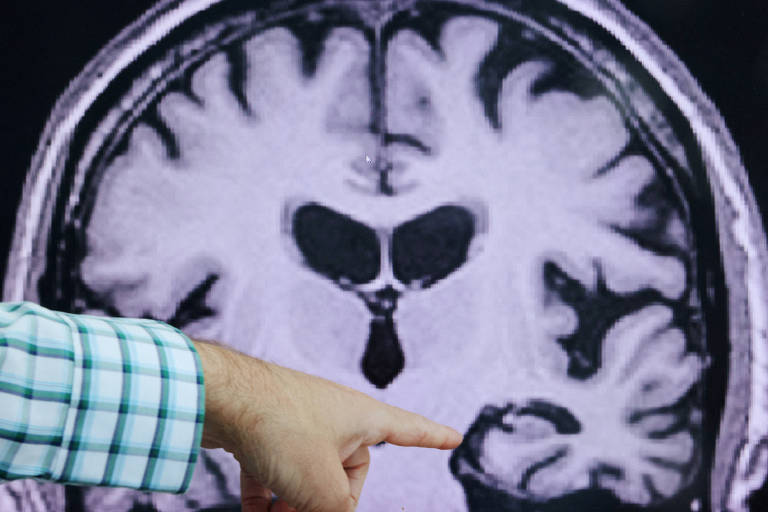 Alzheimer foi transmitido entre humanos em procedimento com hormônios agora proibido