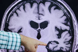 FILE PHOTO: Evidence of Alzheimer?s disease on PET scans at the Center for Alzheimer Research and Treatment in Boston