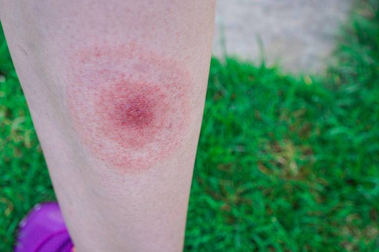 O eritema migratório pode se expandir rapidamente pela pele e é característica da doença de Lyme