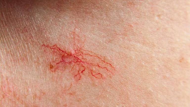 aranhas vasculares na pele