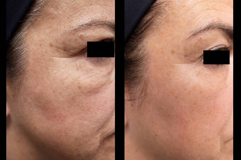 Fotos de antes e depois mostram o perfil de uma paciente branca que não é identificada com uma tarja preta nos olhos