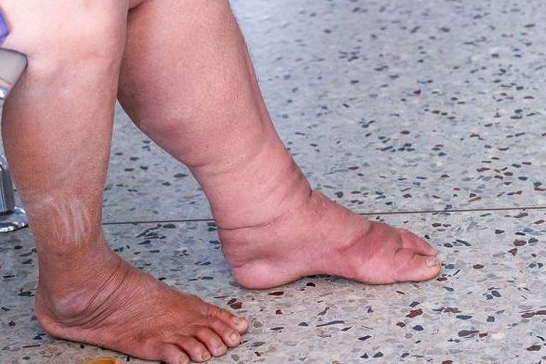 Pernas de uma mulher com filariose