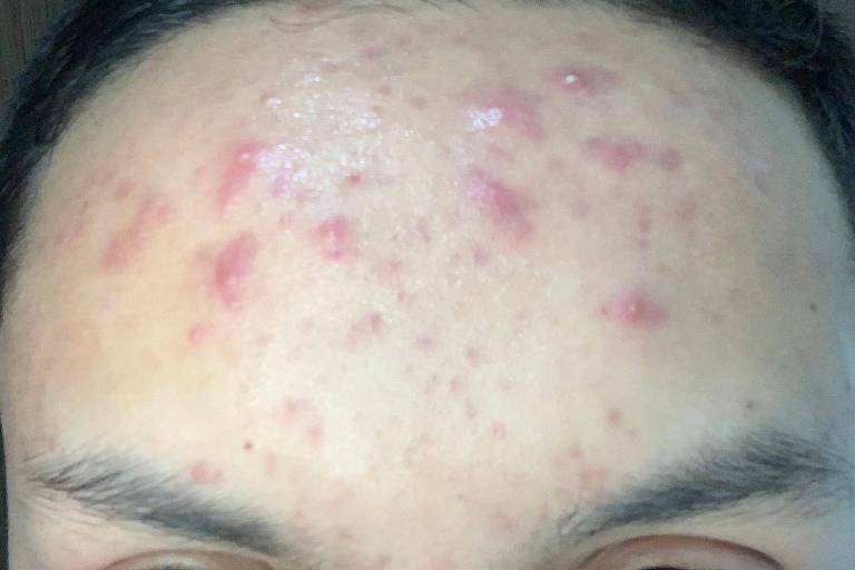 Testa de homem branco com acne inflamada.