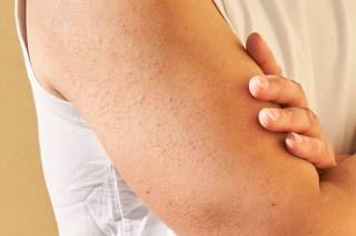 Keratosis pilaris is a common skin condition. It?s also easily treated at home. (Joyce Lee for The New York Times)