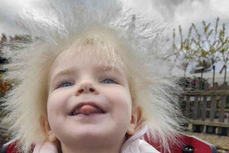 O que é a síndrome do cabelo impenteável: 'O cabelo da minha filha é lindo'