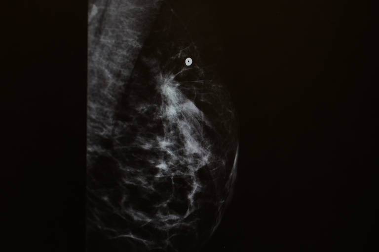 Imagem de mamografia com nódulo identificado por inteligência artificial
