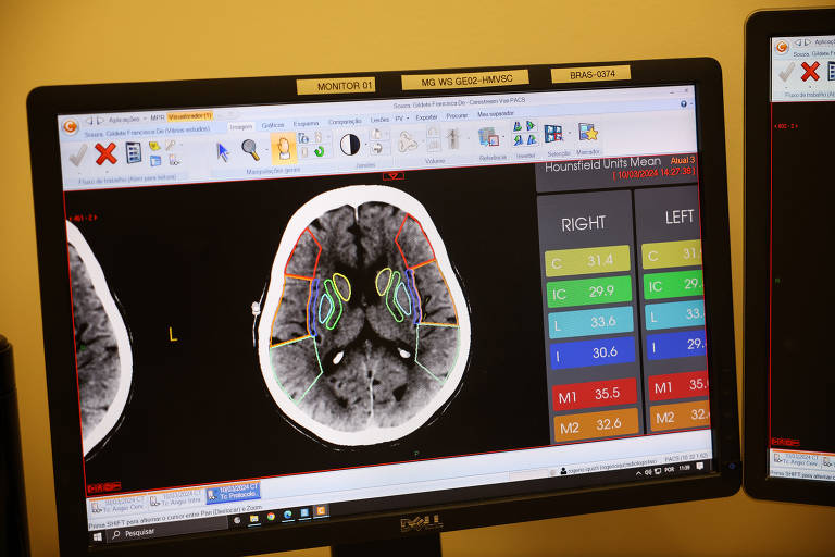 A IA identifica em tempo real a área de AVC e o classifica em uma escala de análise de tamanho de área de infarto