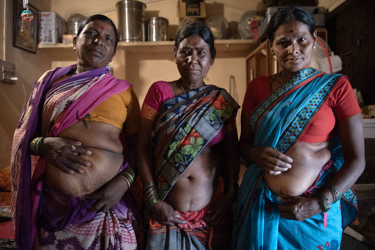 omen who work in the sugarcane fields, all of whom have undergone hysterectomy surgeries, show their scars 