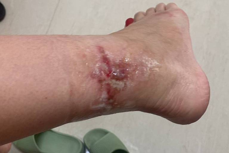 'Senti minha pele sendo queimada viva', diz paciente que fez spa dos pés