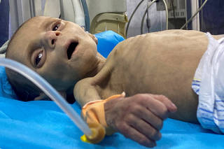 Palestinian toddler battles with malnutrition in Gaza
