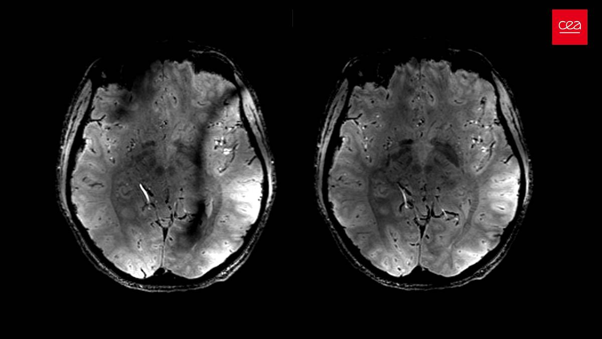 Com IA, cientistas conseguem prever envelhecimento cerebral