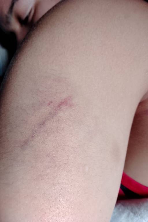 Mulher agredida por policial militar no metrô de SP mostra machucados