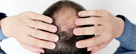 Baldness, man in a shirt concerned about hair loss. Male head with a bald - (Photo: Oleg/AdobeStock) DIREITOS RESERVADOS. NÃO PUBLICAR SEM AUTORIZAÇÃO DO DETENTOR DOS DIREITOS AUTORAIS E DE IMAGEM