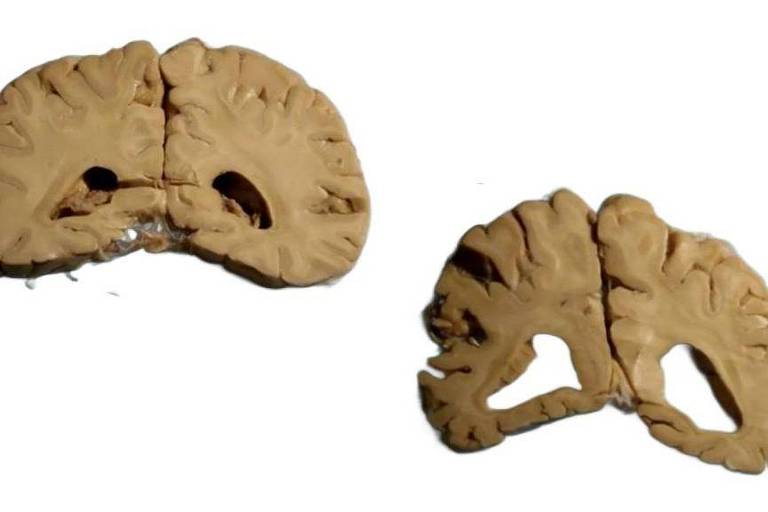 à esquerda, corte de cérebro maciço, com menores buracos. à direita, cérebro com partes que parecem ocas