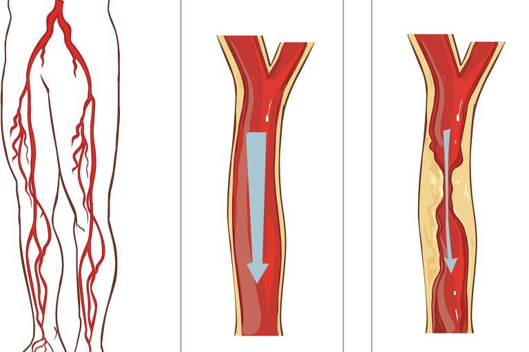 Ilustração do músculo sóleo