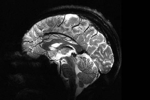 imagem do cérebro humano feita por aparelho de ressonância magnética (IRM) mais potente do mundo na França
( Foto: Comissão de Energia Atômica da França  ) DIREITOS RESERVADOS. NÃO PUBLICAR SEM AUTORIZAÇÃO DO DETENTOR DOS DIREITOS AUTORAIS E DE IMAGEM