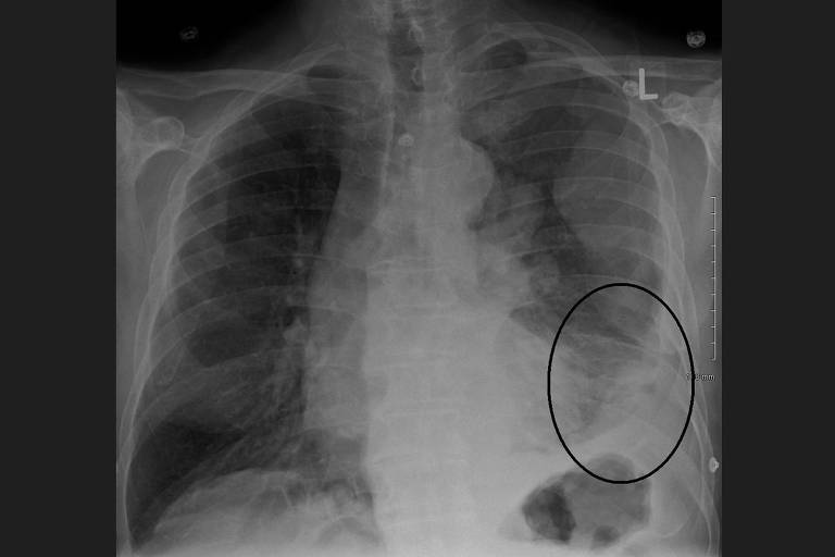 imagem raio x de pulmão