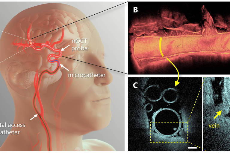 O OCT (tomografia de coerência óptica, na sigla em inglês) miniaturizado é uma nova ferramente para diagnóstico e tratamento de doenças cerebrais vasculares