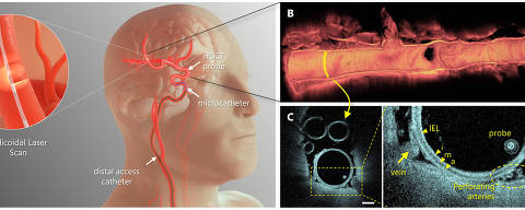 Modelo do uso em paciente in vivo do dispositivo para acompanhamento de procedimentos cerebrais, como para tratamento de aneurismas e AVCs