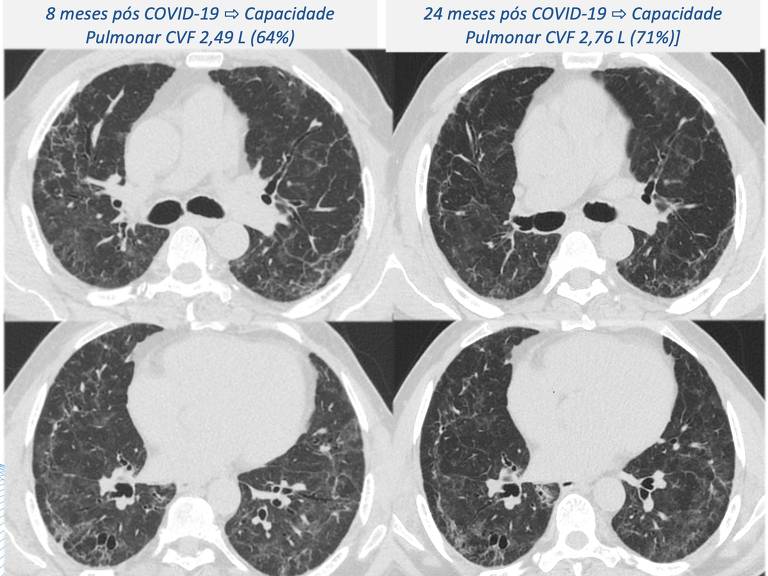 foto mostra quatro imagens raio-x de pulmões