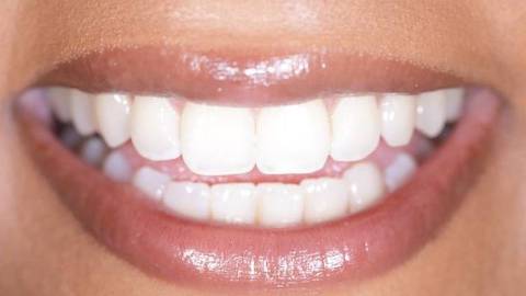 Lentes de contato dentais são a esperança para um sorriso branco, mas têm custos