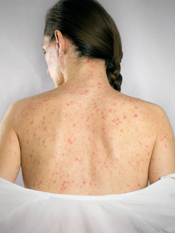 Foto conceitual de uma mulher de costas, apresentando manchas vermelhas na pele. Enfermidade. 