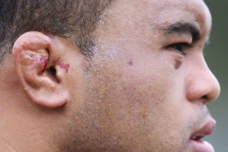 O jogador profissional de rugby Sam Talakai sofreu sangramento nas orelhas de couve-flor em 2018