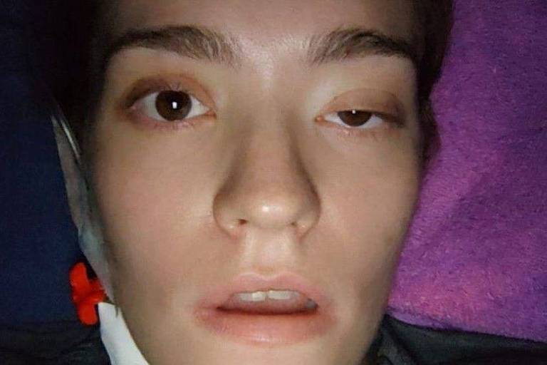 Carolina com metade do rosto paralisado após a última cirurgia