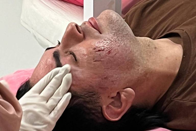 Um homem recebe um tratamento facial por uma profissional com luvas. Ele apresenta vários cortes no rosto, na região das bochechas, parte do tratamento estético