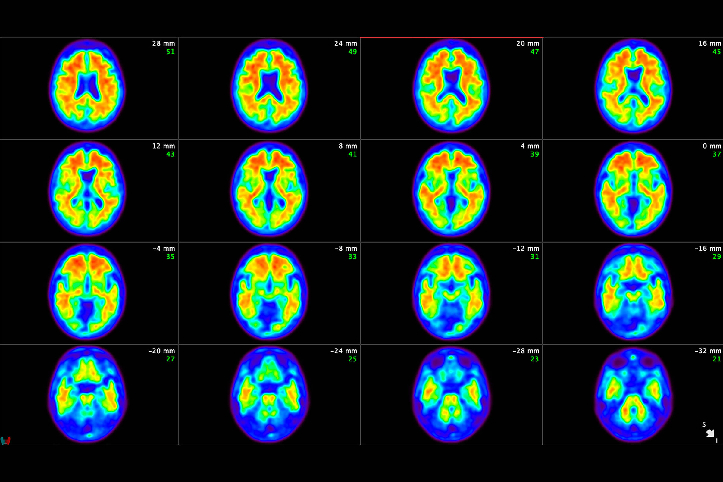 Exame de sangue detecta Alzheimer com mais precisão do que médicos, diz estudo