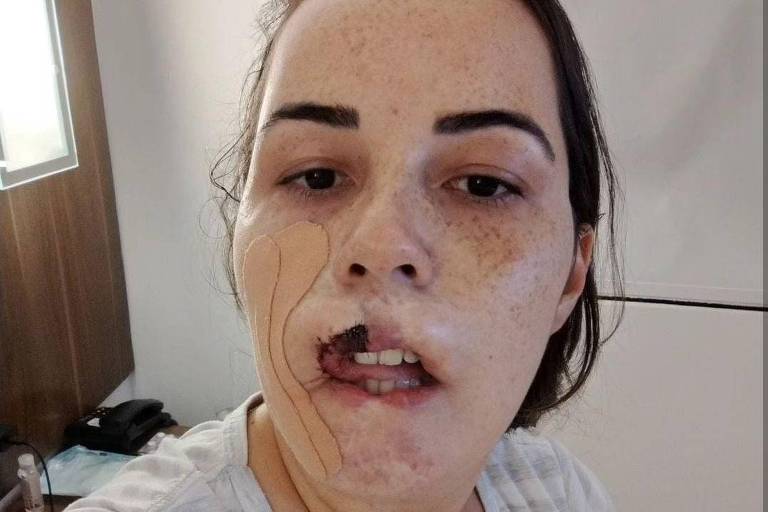 Mulher que perdeu lábio após preenchimento com PMMA faz reconstituição com a língua