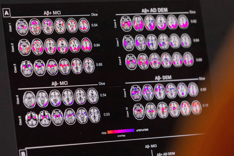 A imagem mostra uma tela de computador exibindo várias imagens de ressonância magnética do cérebro, marcadas com cores para indicar diferentes regiões e possíveis áreas de interesse médico. As imagens são acompanhadas de legendas e valores numéricos que sugerem uma análise quantitativa, possivelmente relacionada a estudos de condições neurodegenerativas como a doença de Alzheimer