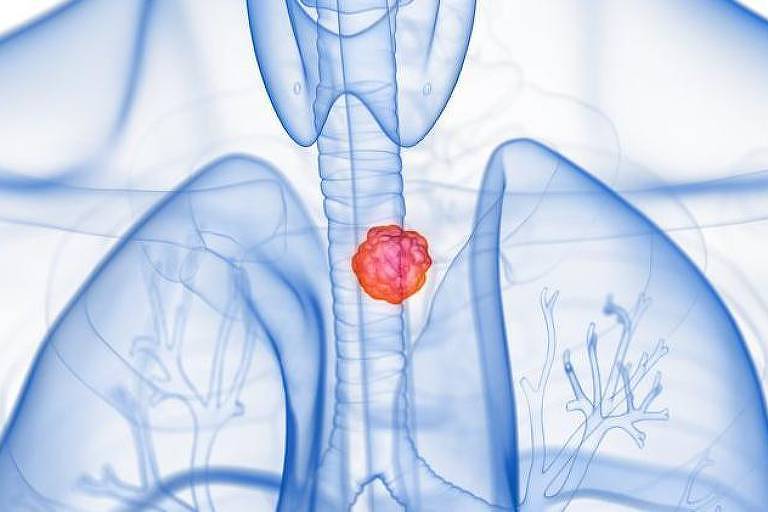 A imagem é uma ilustração médica que mostra a parte superior do corpo humano, destacando o sistema respiratório e o esôfago. O esôfago é mostrado em detalhe, com uma área vermelha indicando a presença de um tumor, sugerindo câncer de esôfago. Os pulmões são visíveis em azul translúcido ao redor do esôfago.
