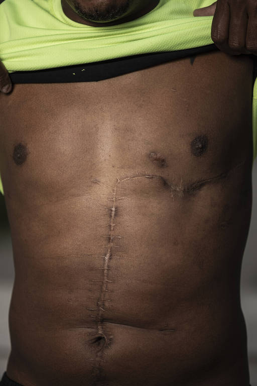 A imagem mostra a parte superior do corpo de uma pessoa levantando a camisa para revelar uma cicatriz vertical no abdômen. A cicatriz parece ser resultado de uma cirurgia. A pele ao redor da cicatriz está intacta e não apresenta sinais de inflamação.