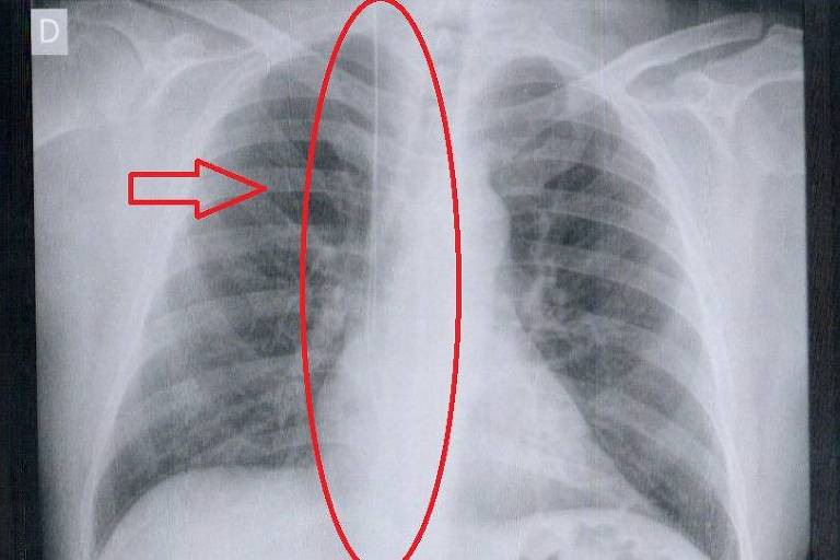 A imagem mostra uma radiografia de tórax com uma área ovalada marcada em vermelho no centro, destacando a região do mediastino. Há também uma seta vermelha apontando para a mesma área. A radiografia revela as estruturas internas do tórax, incluindo os pulmões e a coluna vertebral.