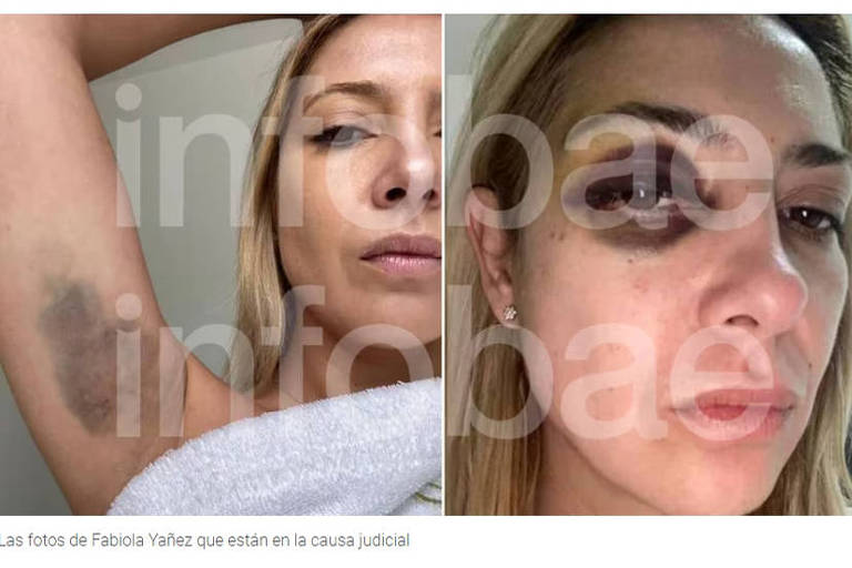 A imagem apresenta duas fotos de uma mulher. Na foto da esquerda, ela mostra uma lesão no braço, enquanto na foto da direita, seu rosto exibe um grande hematoma ao redor do olho. Ambas as fotos parecem ser de um relato de violência.