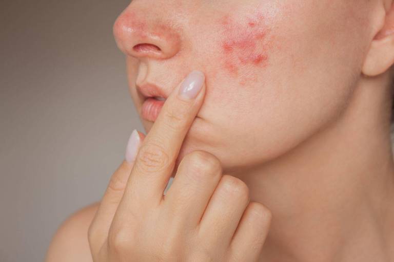 Rosto de mulher jovem com rosácea, manchas avermelhadas nas bochechas.