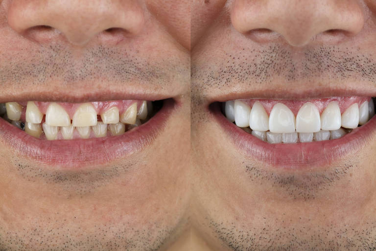 A imagem mostra a comparação de dois sorrisos de uma mesma pessoa. À esquerda, os dentes estão amarelados e apresentam manchas, enquanto à direita, os dentes estão brancos e bem cuidados, evidenciando uma diferença significativa na estética dental.