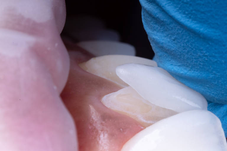 Lentes dentais e facetas de porcelana melhoram aparência dos dentes