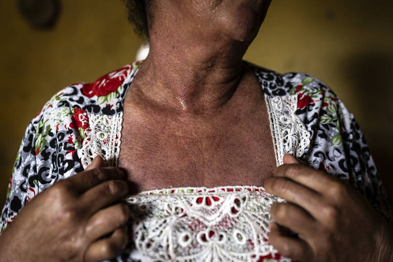 Maria Aparecida de Moraes Ferreira (52), mostra o resultado da alergia mesmo sendo tratada com cremes e medicamentos indicados pelo médico