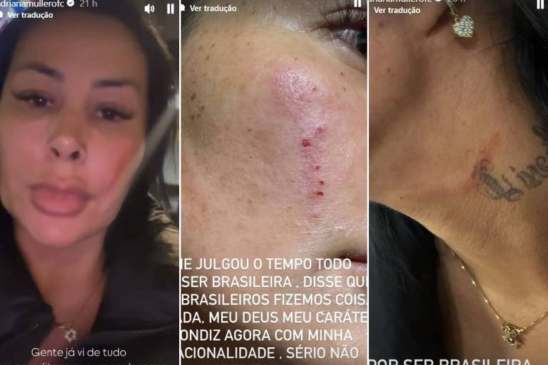 Adriana Mullher mostra as marcas das agressões que sofreu de uma mulher em Portugal