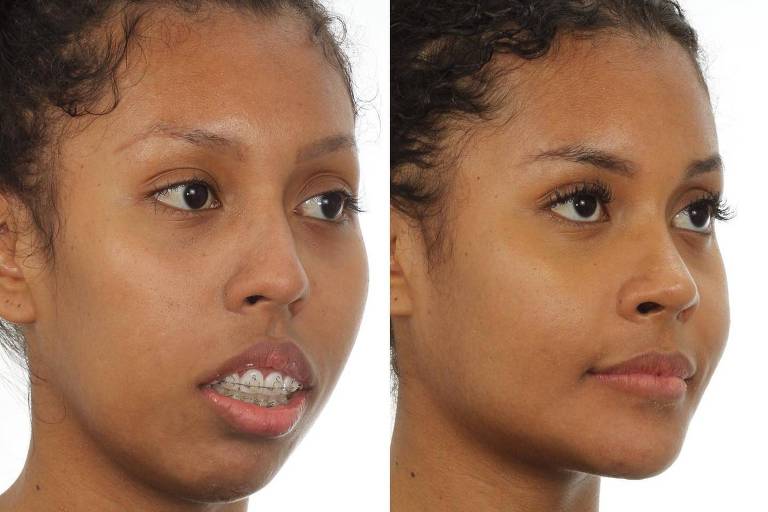 A imagem apresenta duas fotos lado a lado de uma mulher. À esquerda, ela tem aparelho nos dentes e está usando uma camiseta preta. À direita, a mesma mulher aparece sem aparelho, com uma camiseta verde. Ambas as fotos mostram o rosto dela em perfil, destacando diferenças na aparência.